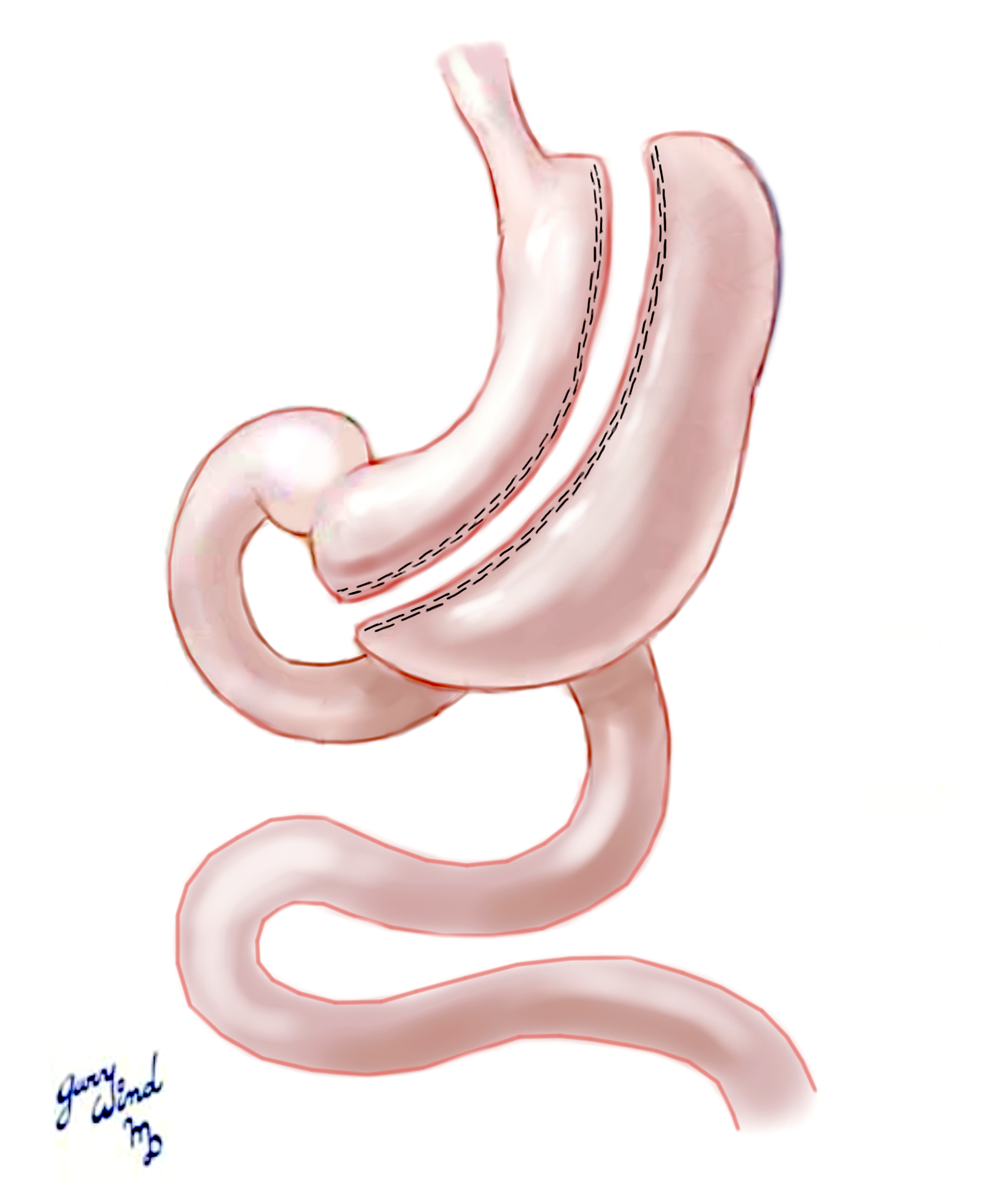 Laparoscopic Sleeve Gastrectomy