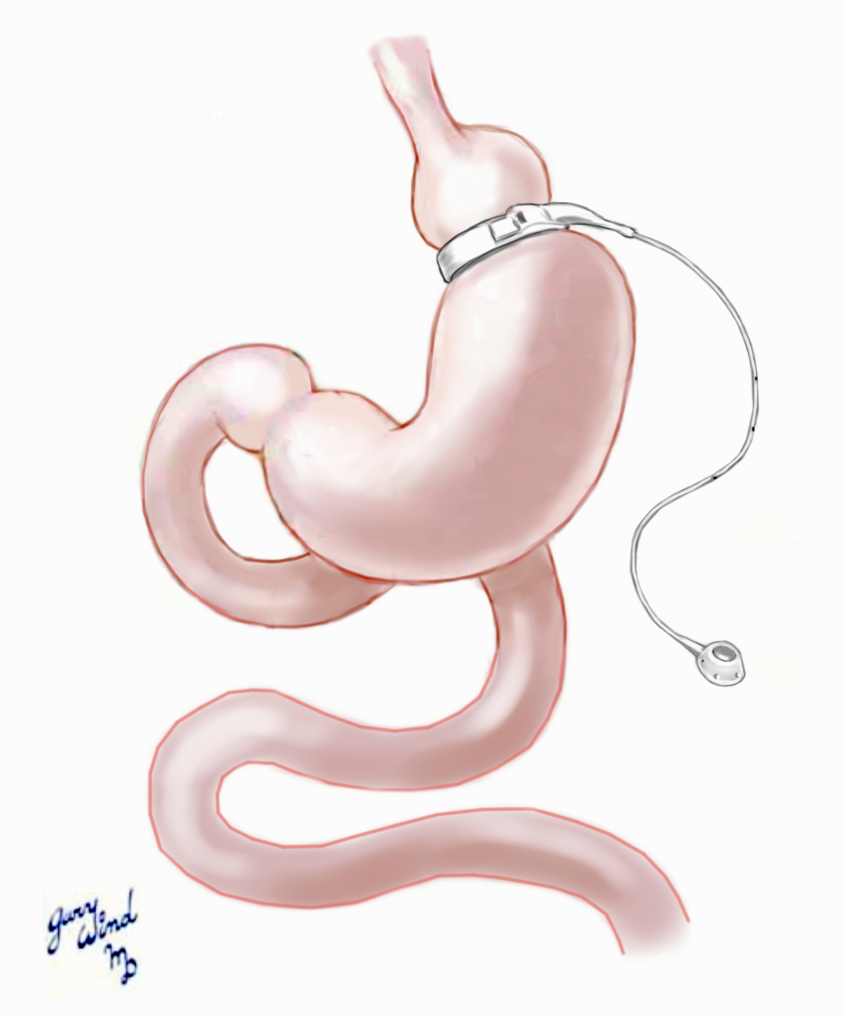 Laparoscopic Gastric Banding