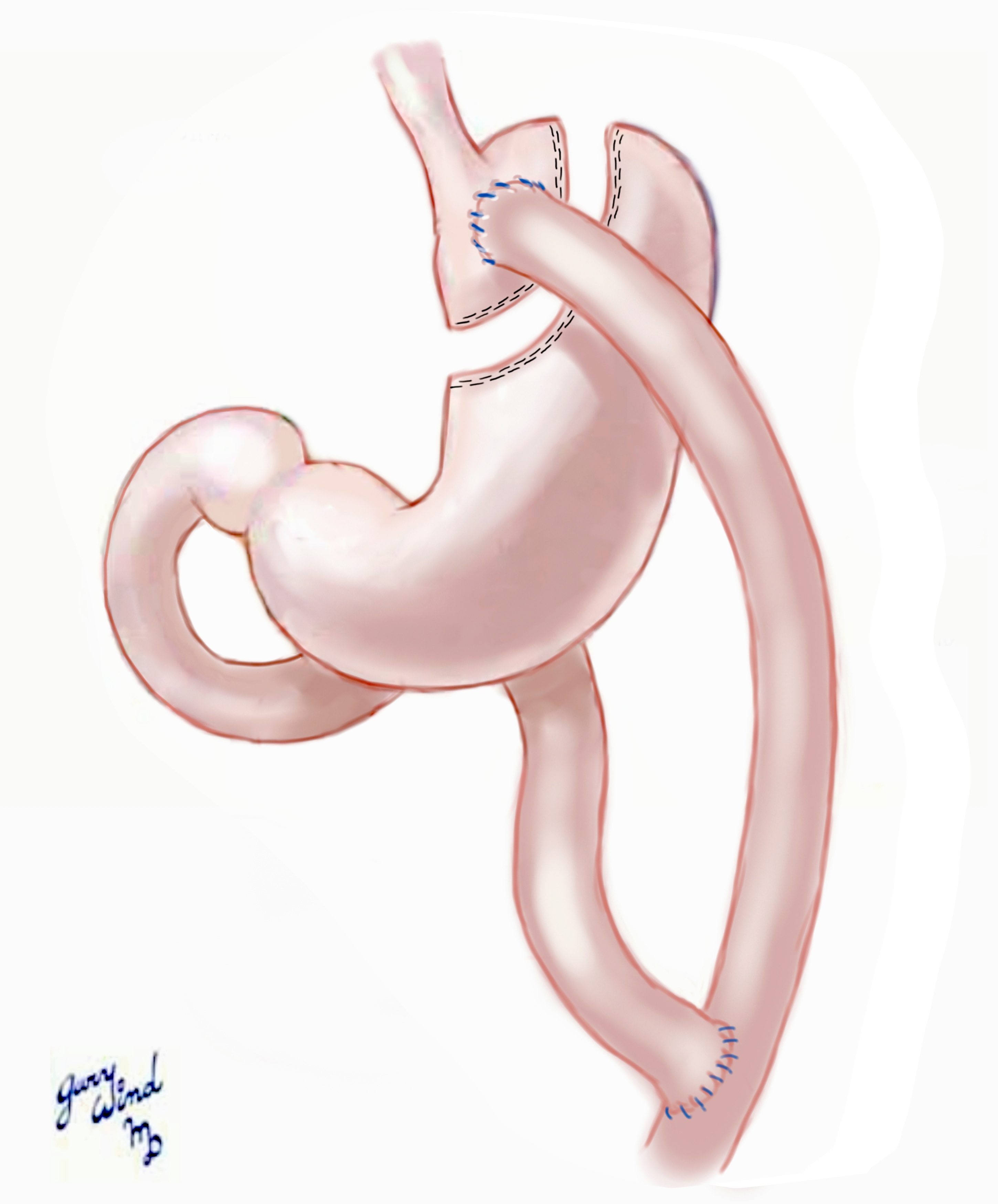 Gastric Bypass